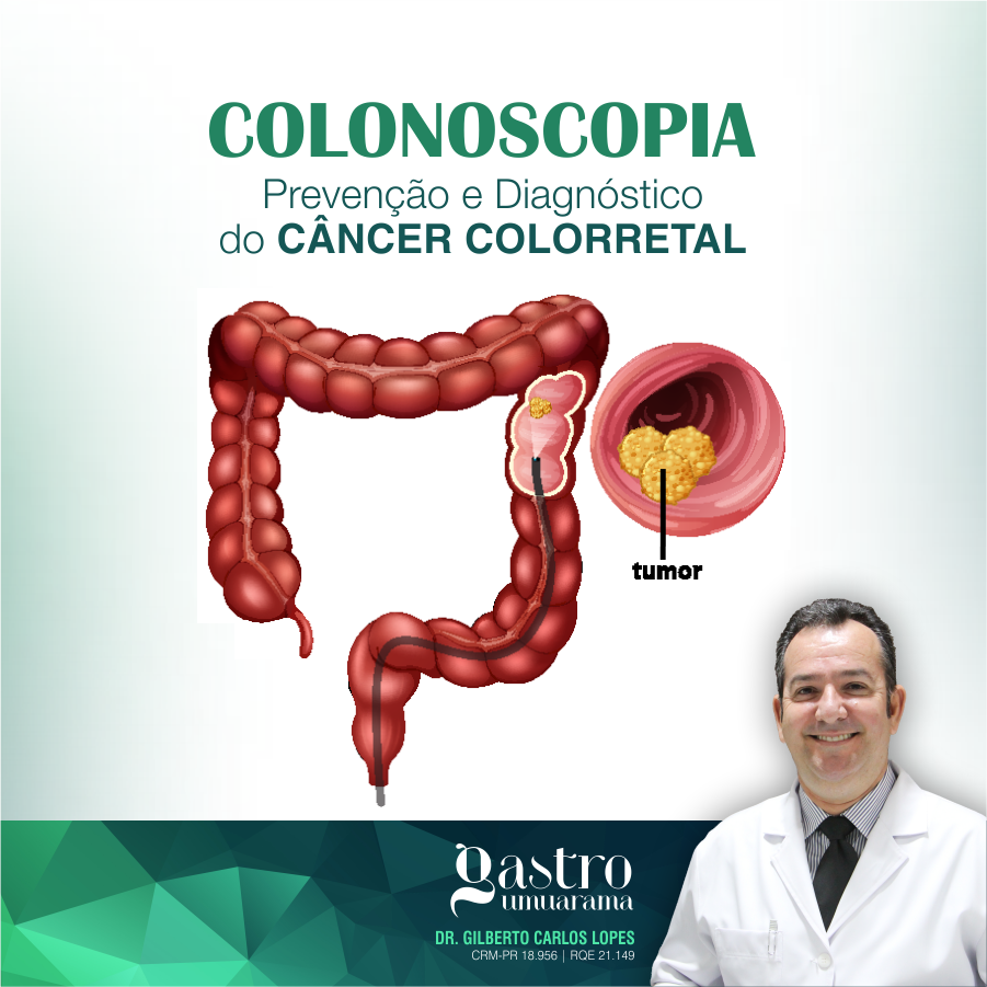 Prevenção e Diagnóstico do Câncer Colorretal