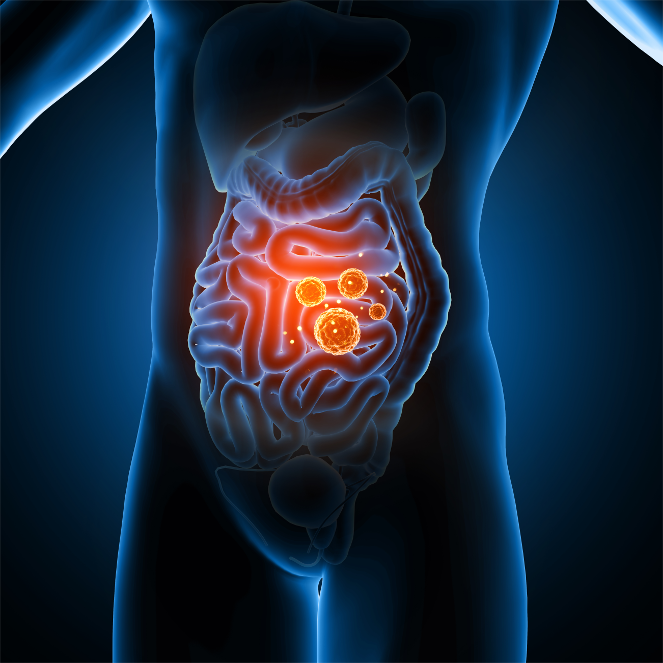 Carnes Processadas e o Câncer de Intestino