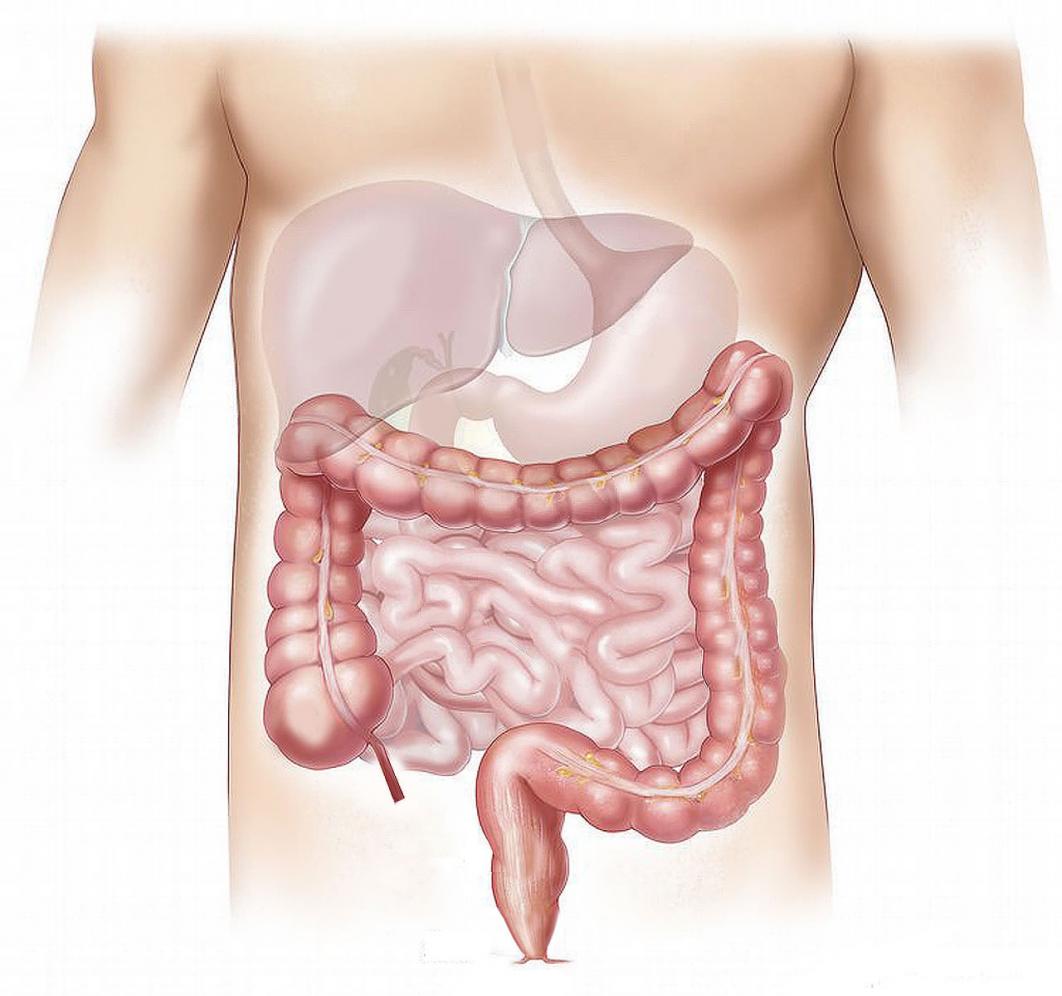 DII - Doenças Inflamatórias Intestinais