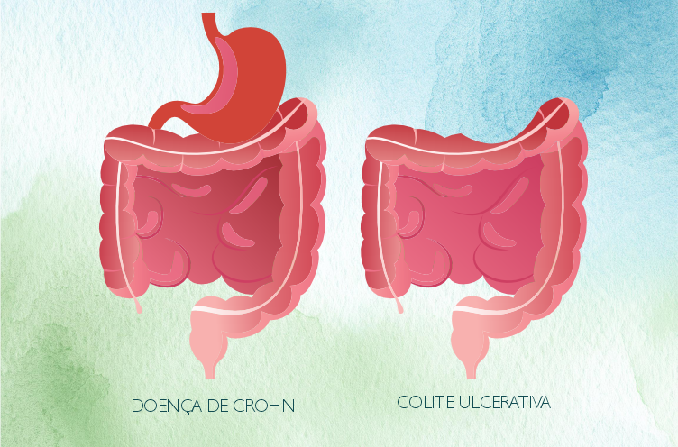 Doença de Crohn e a Colite Ulcerativa
