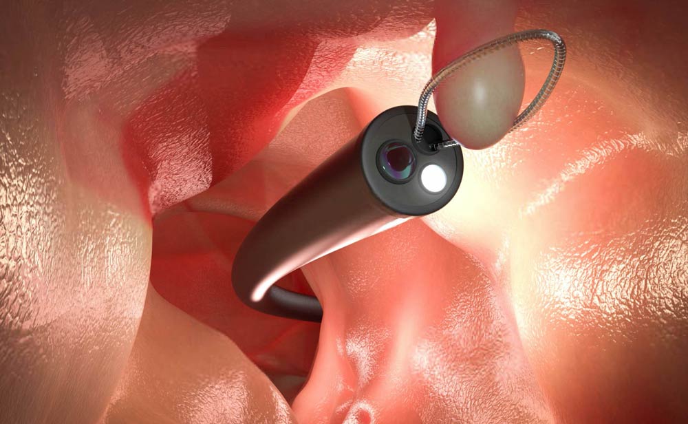 Colonoscopia | Diagnóstico e Cirurgia