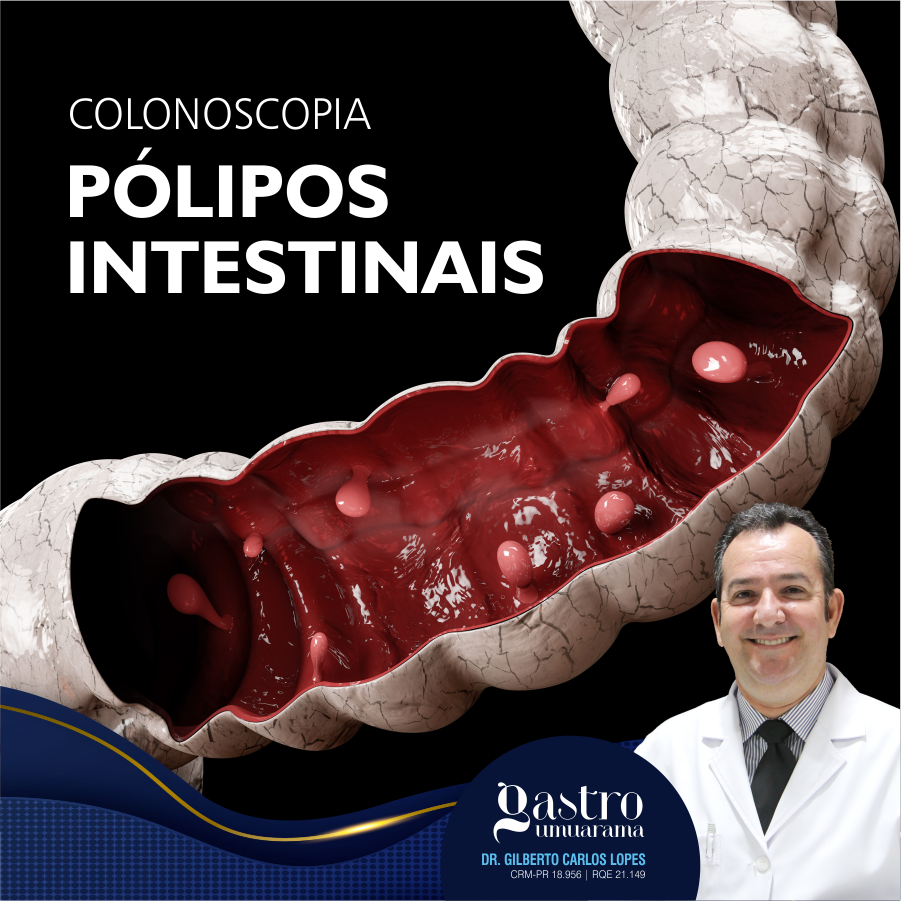 Remoção de Pólipos Intestinais