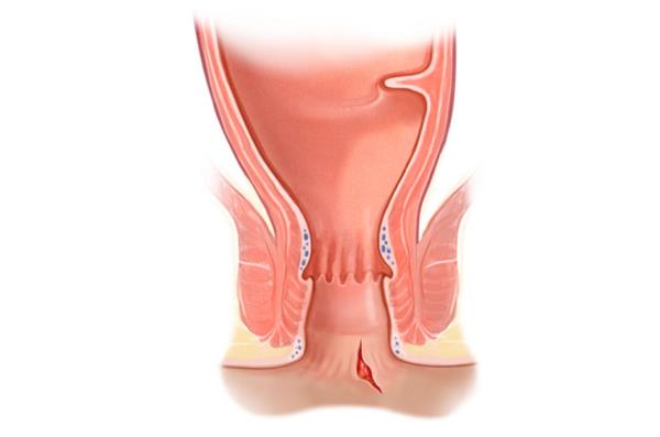 Você sabe o que é Fístula Anal?