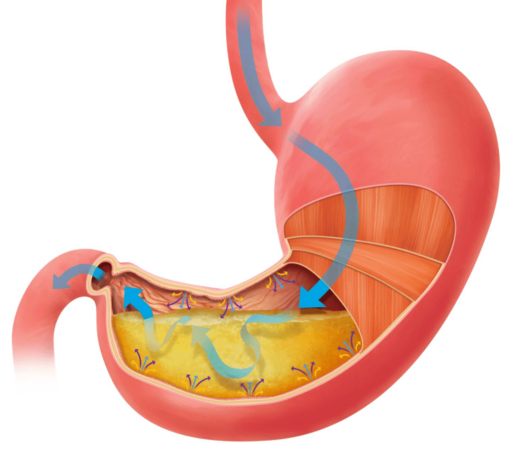 Gastroparesia