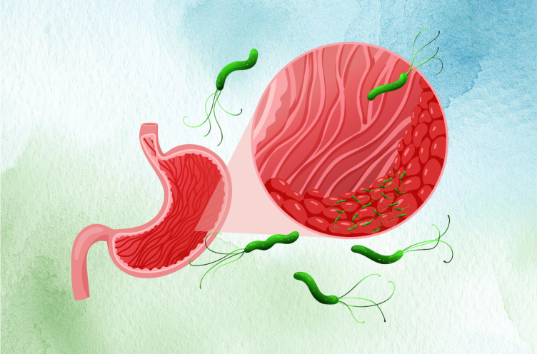 Helicobacter pylori 