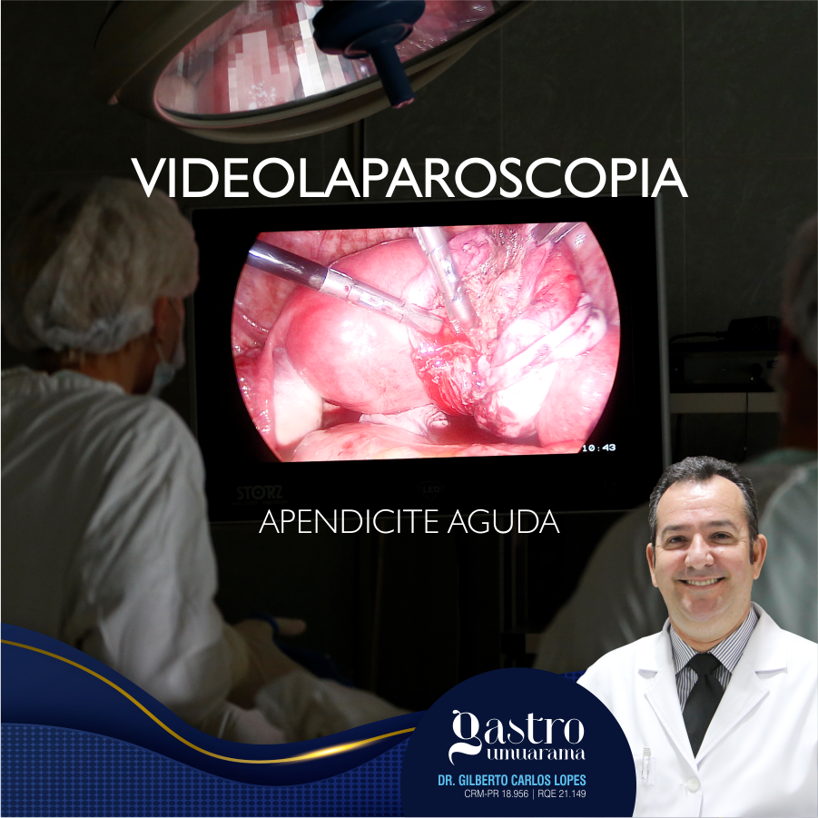 Apendicite Aguda | Videolaparoscopia